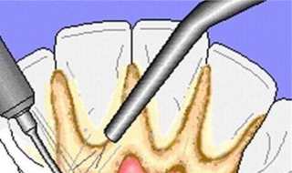 牙结石怎么去除 如何预防牙结石
